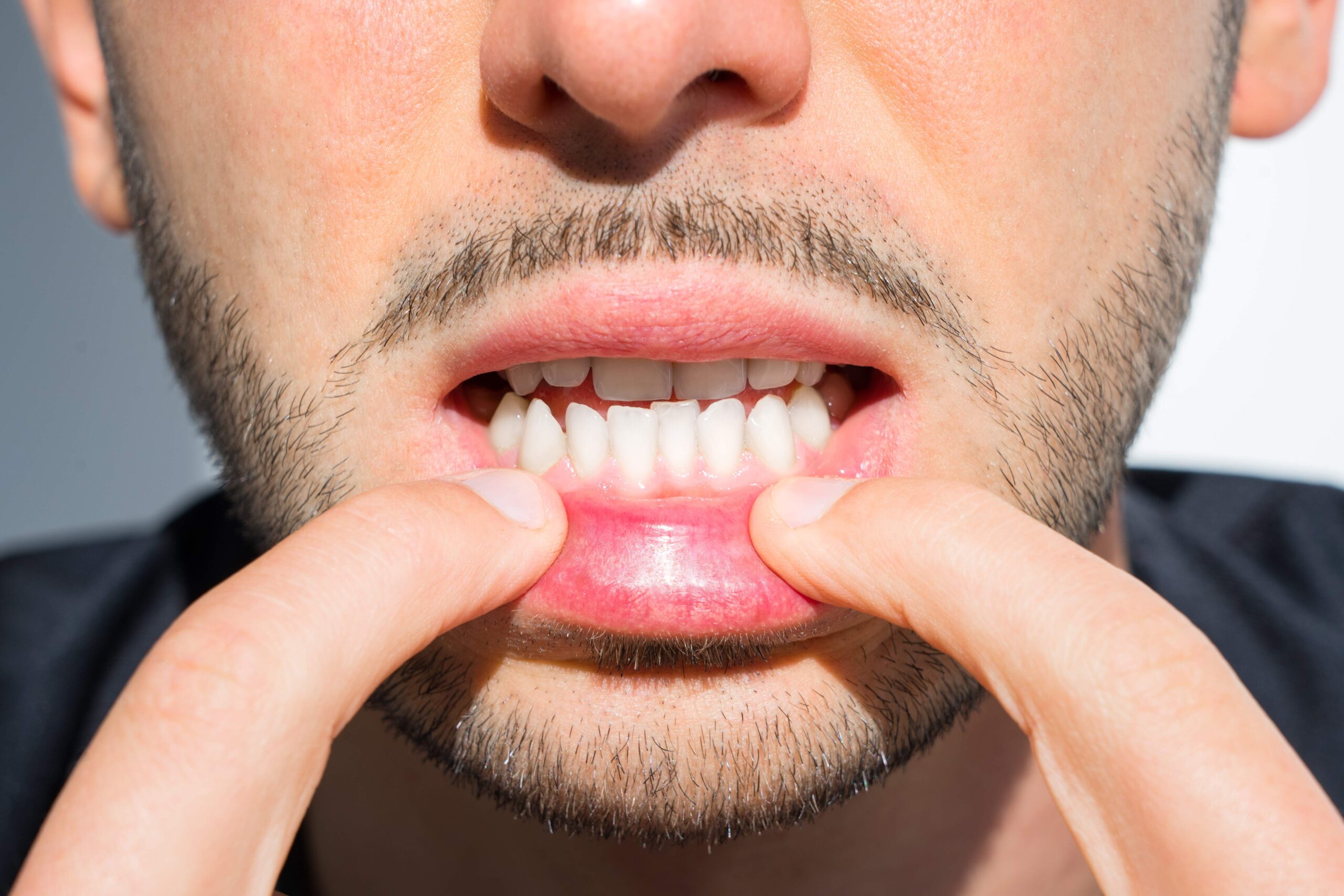 How Braces Can Help Correct an Underbite